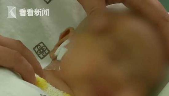 女嬰兩天哭鬧不止竟因頭發(fā)絲繞腳趾
